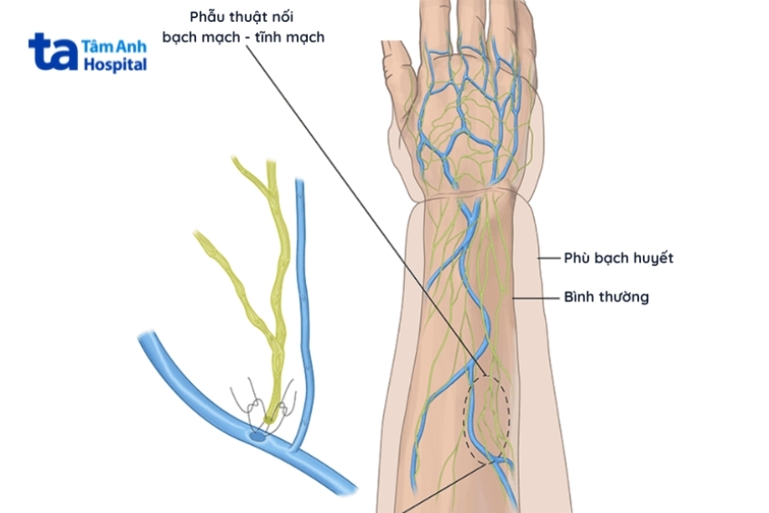 phương pháp nối bạch - tĩnh mạch