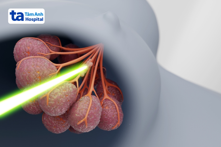 phương pháp sử dụng chùm bức xạ nhắm vào một phần của cơ thể