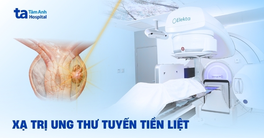 Phương pháp xạ trị ung thư tuyến tiền liệt có hiệu quả không?