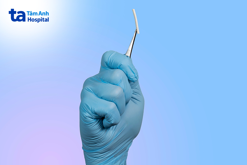 Bác sĩ đeo găng tay y tế đang cầm que tránh thai Implanon NXT