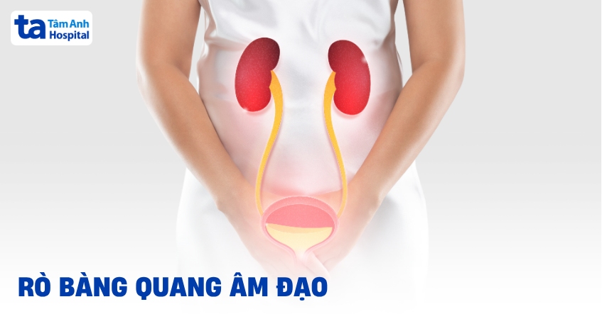 Rò bàng quang âm đạo phải làm sao? Nguyên nhân do đâu?