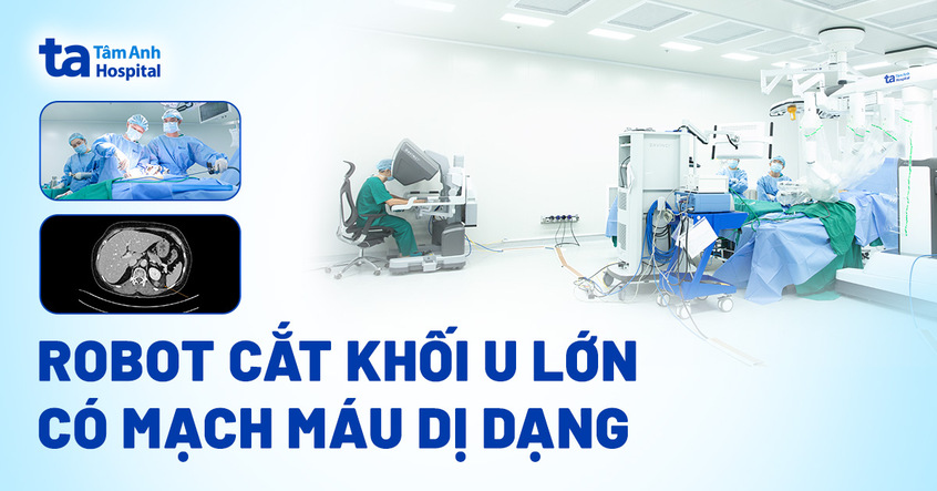 Robot cắt khối u lớn có mạch máu dị dạng