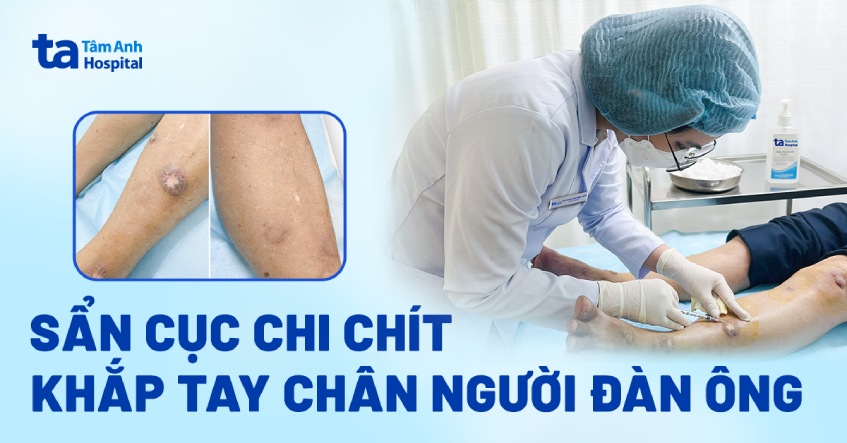 sẩn cục chi chít khắp tay chân người đàn ông
