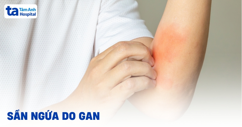 Sẩn ngứa do gan: Nhận biết và phân biệt với ngứa da thông thường
