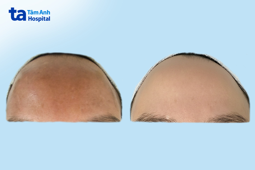 sau 1 năm kiên trì điều trị