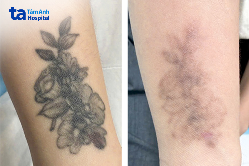 sau 9 lần xóa xăm đã mờ dần