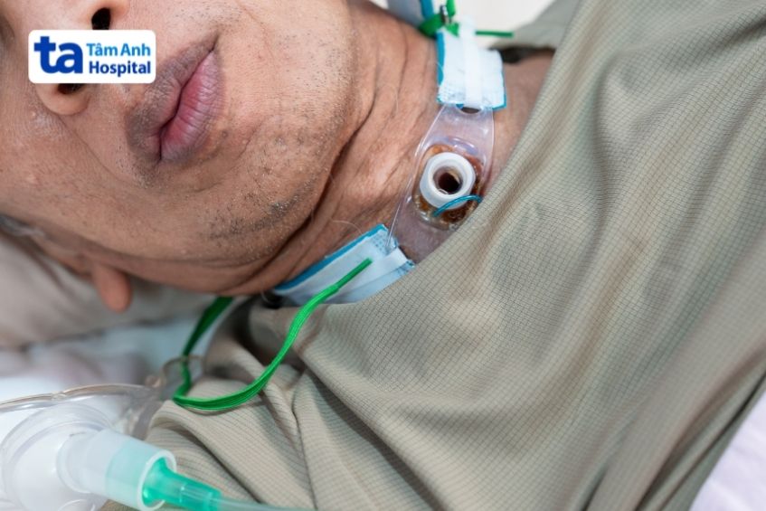 sau khi được rút ống nội khí quản cần tiếp tục theo dõi