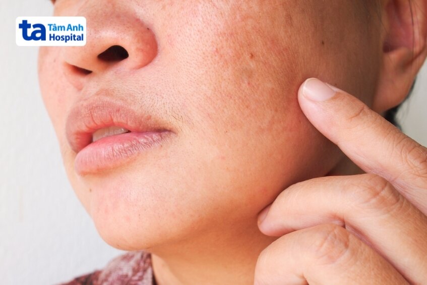 sau peel da bị thâm sạm vì nhiều lý do