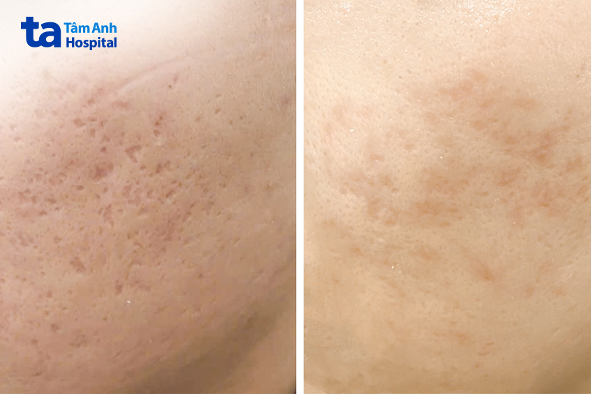 sẹo rỗ đã giảm đi đáng kể