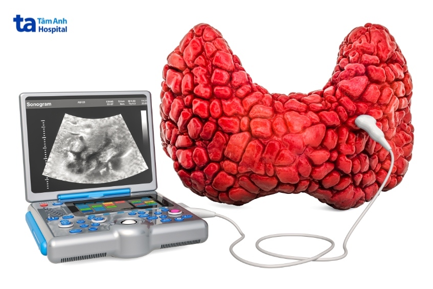 siêu âm có thể giúp phát hiện, đánh giá tình trạng nhân tuyến giáp