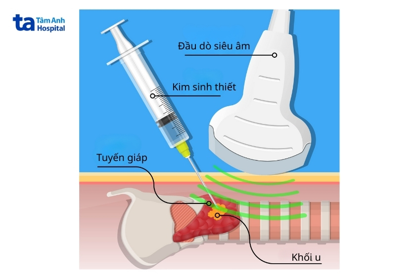 sinh thiết là phương pháp chẩn đoán ung thư tế bào ái toan quan trọng
