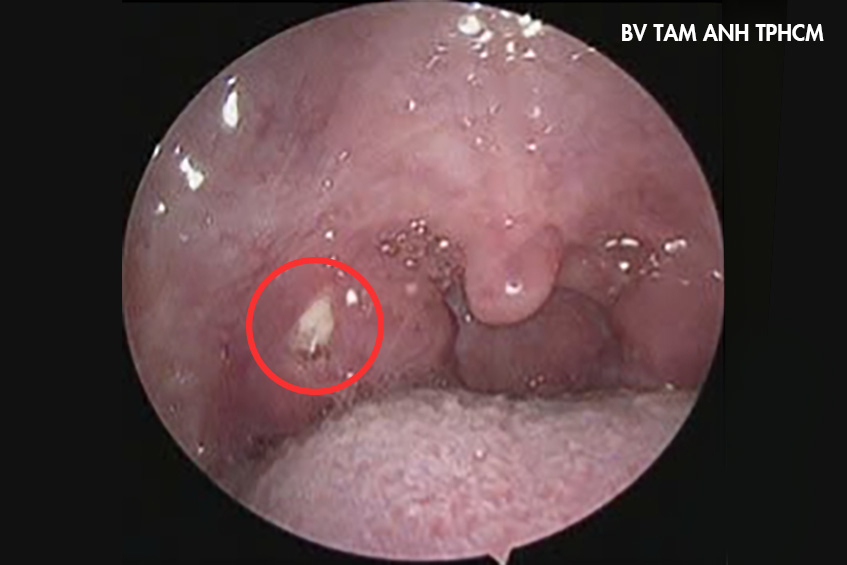 sỏi màu trằng nằm trong hốc amidan
