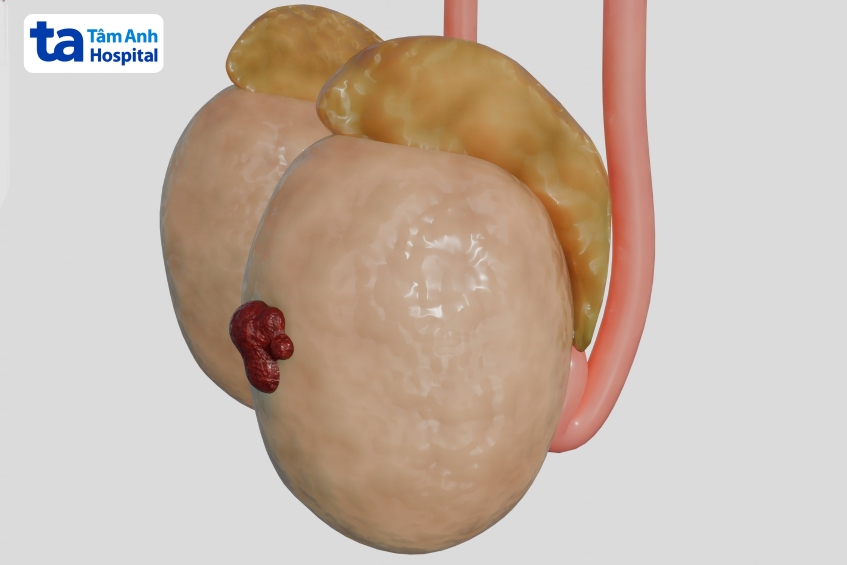 Sự xuất hiện của mô cứng vùng bìu có thể là dấu hiệu bướu ở tinh hoàn