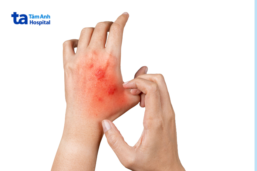 Vùng da tay bị nổi mẩn đỏ có thể là tác dụng phụ hiếm gặp của thuốc