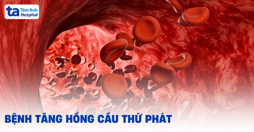 Bệnh tăng hồng cầu thứ phát và những điểm cần lưu tâm