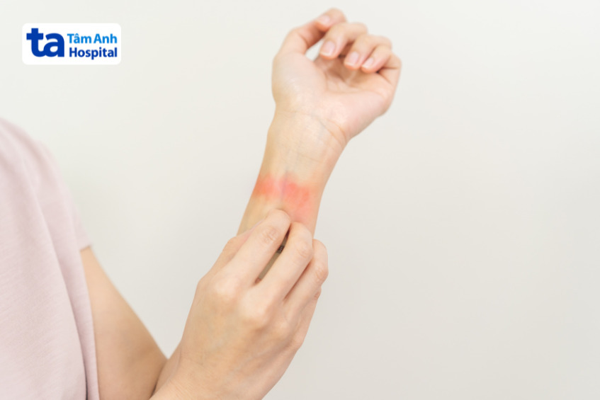 tay nổi mề đay, ngứa