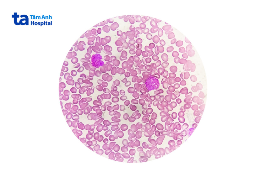 Tế bào hồng huyết cầu bất thường ở người bệnh thalassemia