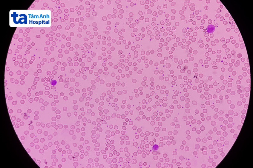 tế bào hồng cầu bị lỗi