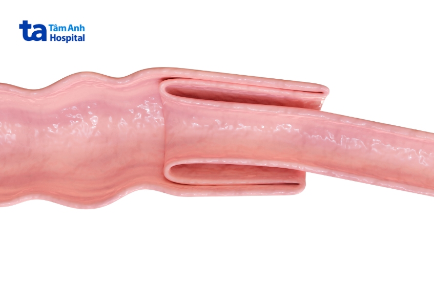 tháo lồng ruột bằng hơi