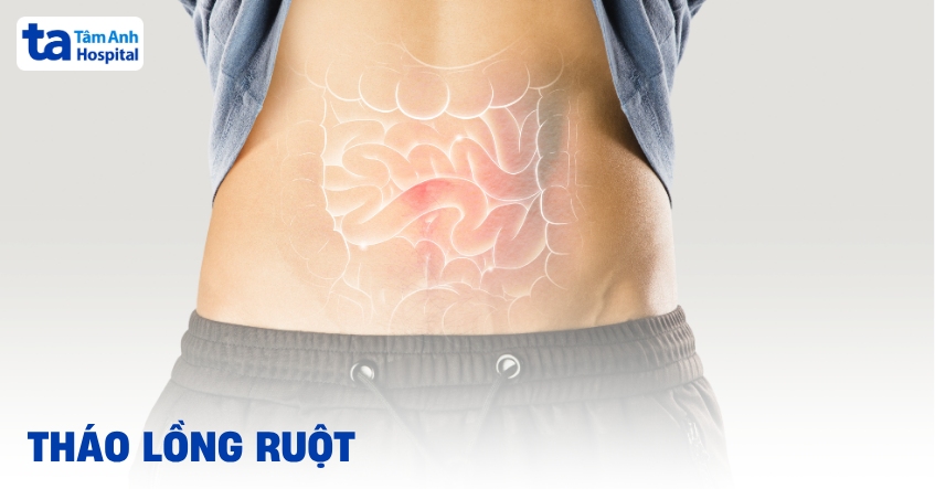 Tháo lồng ruột: Những điều bệnh nhân và gia đình cần biết