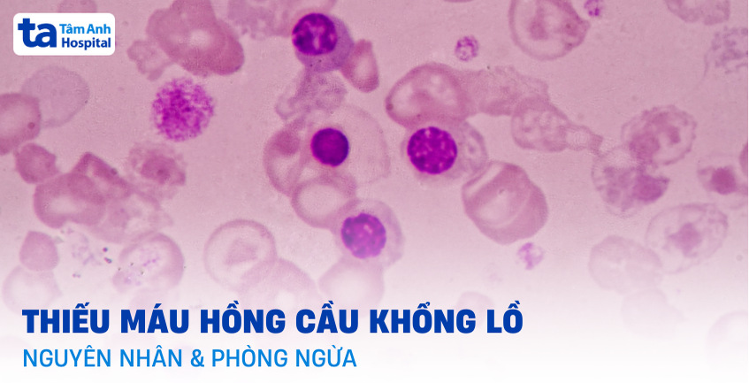 Thiếu máu hồng cầu khổng lồ là bệnh gì? Nguyên nhân và phòng ngừa