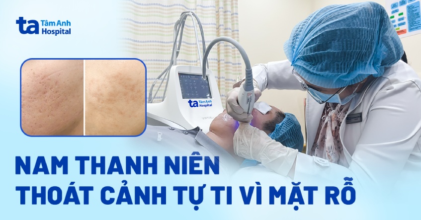 thoát cảnh tự ti vì mặt rỗ