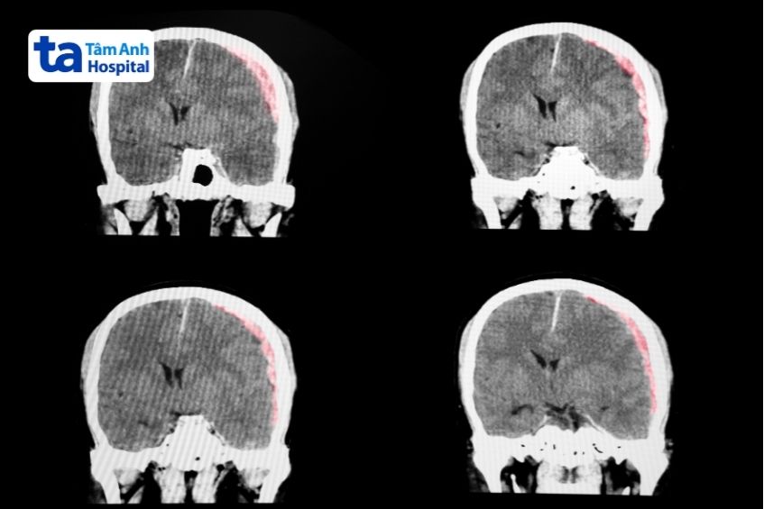 thời gian hồi phục còn tùy thuộc vào mức độ tổn thương não