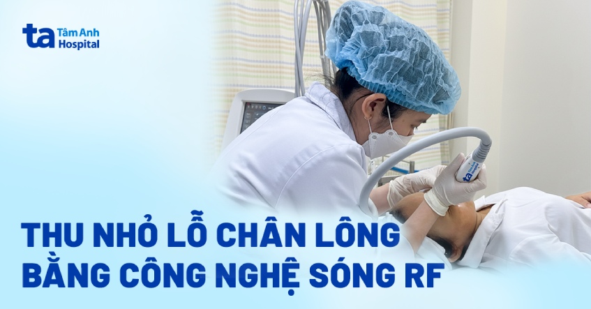 Thu nhỏ lỗ chân lông bằng công nghệ sóng RF