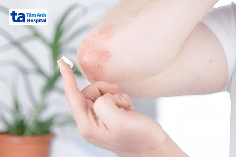 thuốc bôi ngoài da điều trị vảy nến
