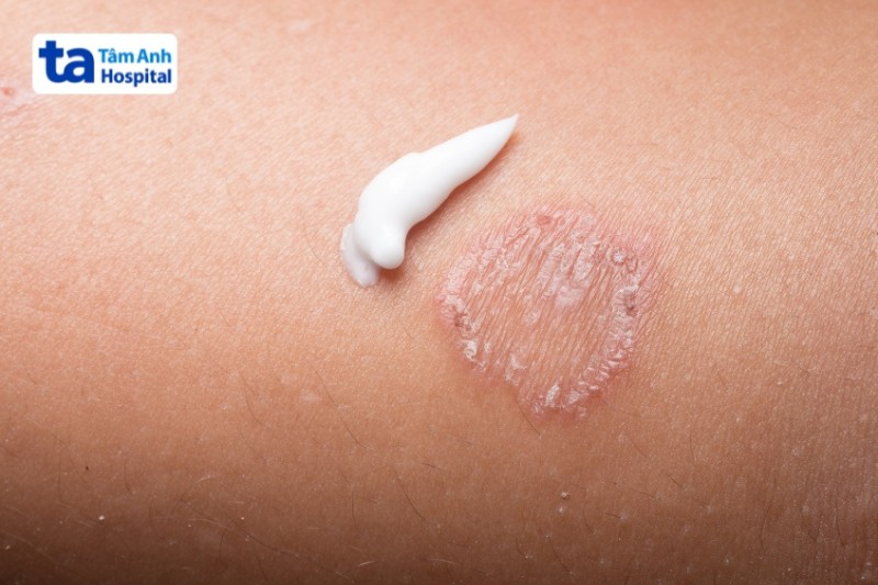 thuốc bôi da vảy nến ở mặt