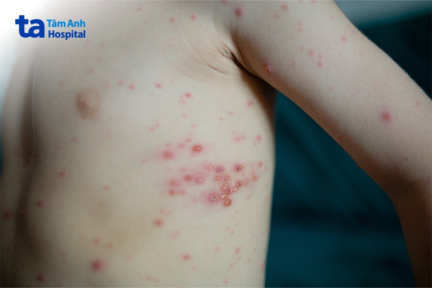 thủy đậu và phỏng dạ đều là một bệnh