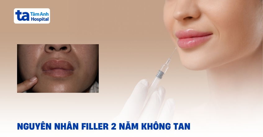 Tiêm filler 2 năm không tan: Chiêu trò quảng cáo hay biến chứng?