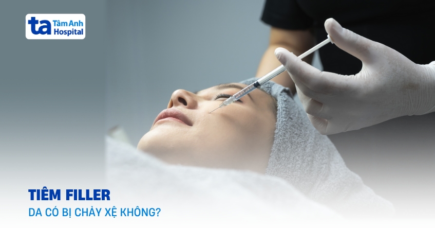 Tiêm filler bị chảy xệ phải xử trí làm sao? Nguyên nhân do đâu?