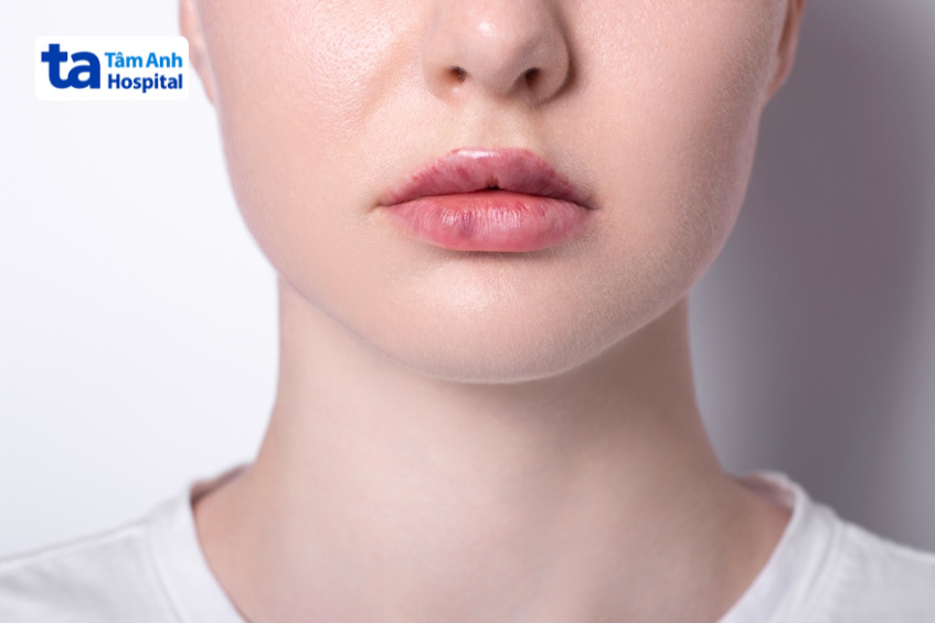 tiêm filler không tan là như thế nào