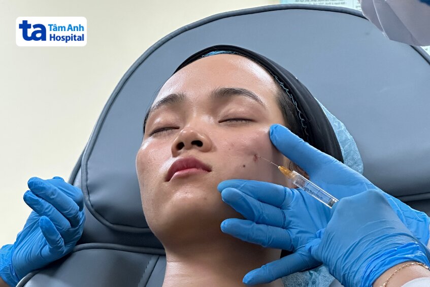 tiêm filler làm đầy sẹo lõm có hiệu quả không