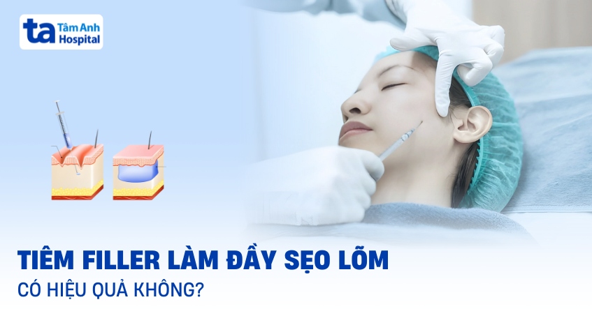 Giải đáp: Tiêm filler làm đầy sẹo lõm có hiệu quả không?