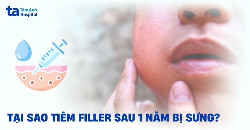 Liệu tiêm filler sau 1 năm bị sưng đau cảnh báo điều gì?