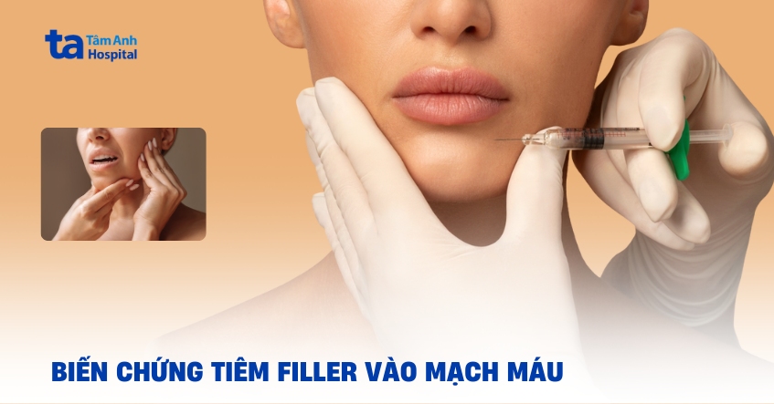 Biến chứng tiêm filler vào mạch máu có xử lý được không?