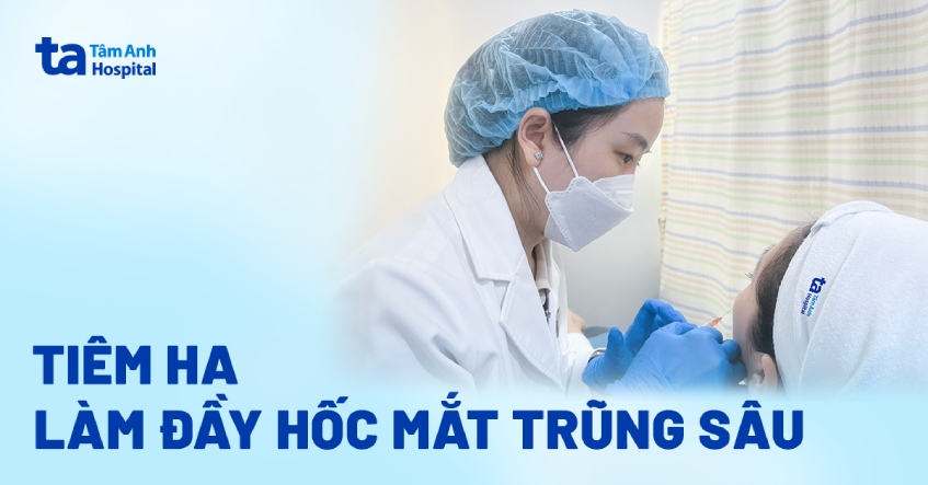 Tiêm HA làm đầy hốc mắt trũng sâu