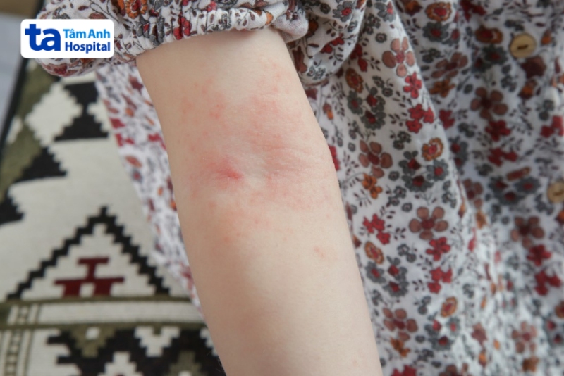tổn thương da do viêm da cơ địa