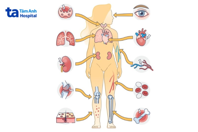 tổn thương hệ tuần hoàn do lupus ban đỏ