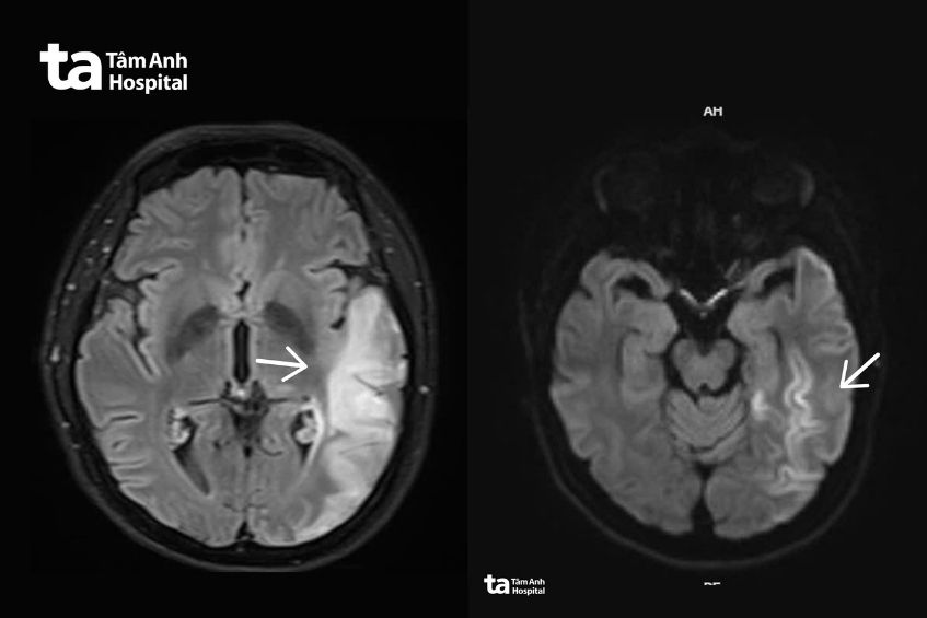 tổn thương não bất thường