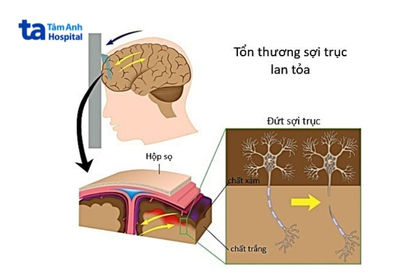 tổn thương sợi trục