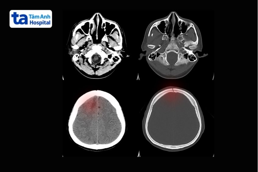 tổn thương xương sọ