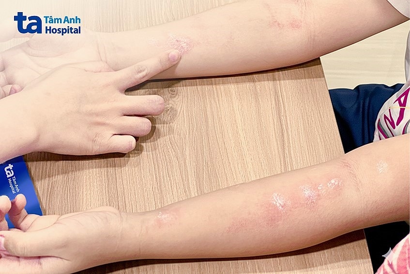 trẻ được điều dưỡng bôi thuốc giảm ngứa sau khi hoàn thành test dị nguyên. ảnh bệnh viện đa khoa tâm anh