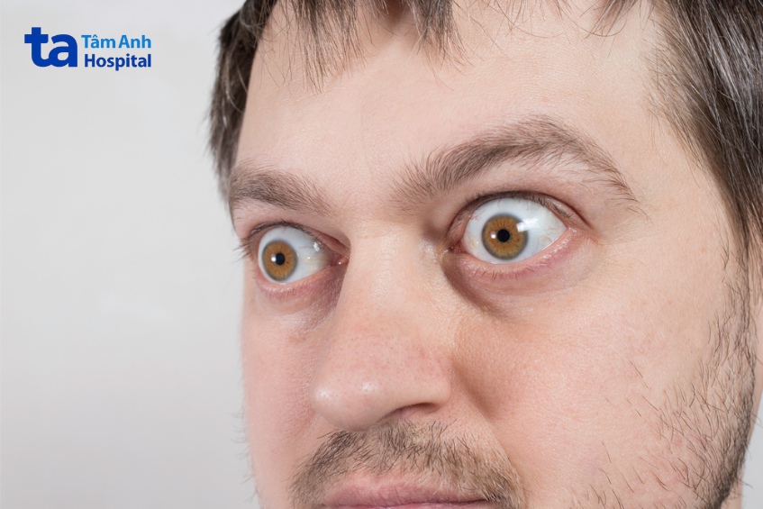 triệu chứng của lồi mắt basedow là thay đổi hình dáng mắt