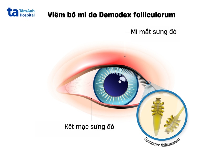 triệu chứng nhận biết viêm bờ mi do demodex