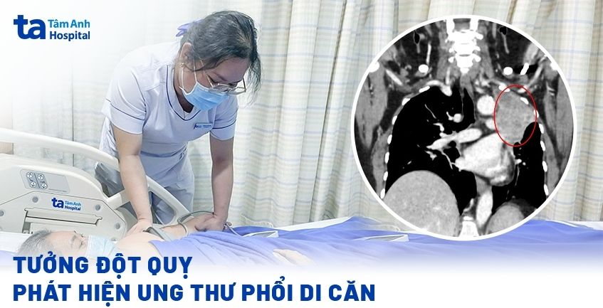 Tưởng đột quỵ, phát hiện ung thư phổi di căn