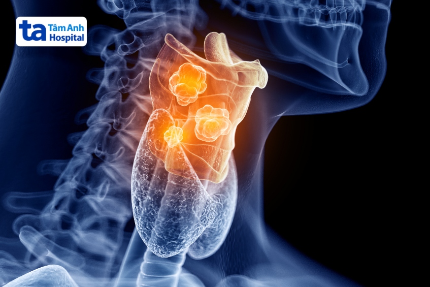 tùy theo giai đoạn và tình trạng khối u, xạ trị có thể áp dụng cho cả khối u nhỏ ở giai đoạn sớm hoặc khối u lan rộng hơn để kiểm soát triệu chứng