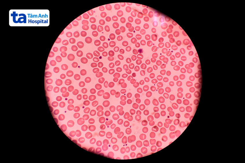 tỷ lệ tế bào hồng cầu stomatocyte trong xét nghiệm phết máu ngoại vi